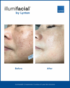 Before& After Illumifacial (1080 x 1350 px) (6)